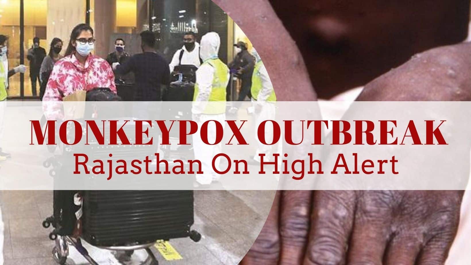 Rajasthan On High Alert Over Monkeypox Outbreak, Advisory Issued For Passengers Travelling From Affected Countries
